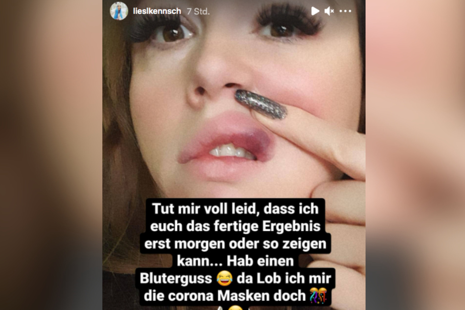 Nach dem Eingriff bildete sich ein fieser Bluterguss. (Screenshot)