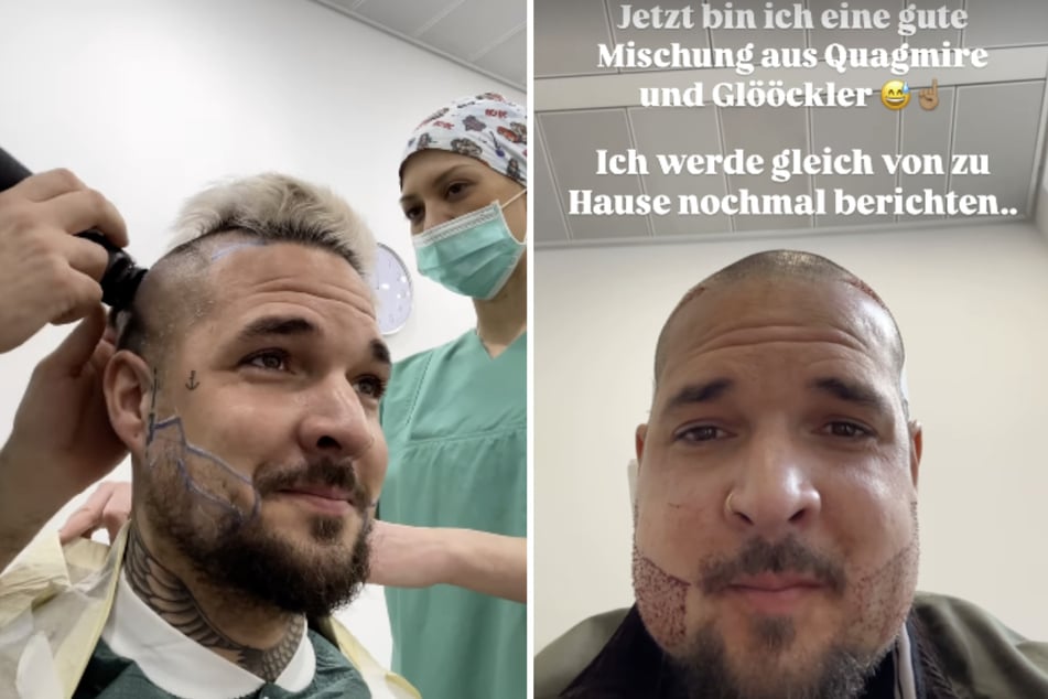 In seiner Instagram-Story hat "Sommerhaus"-Star Zico Banach (34) einige Fotos von dem Eingriff am Donnerstag geteilt.