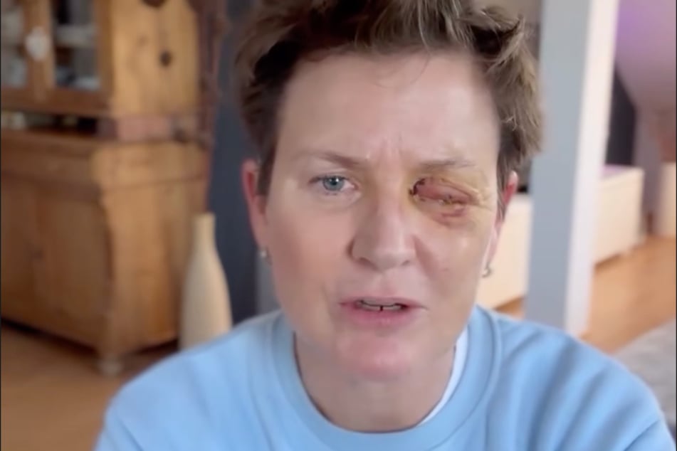 Andrea Plewig (55) verlor ein Auge an Silvester.