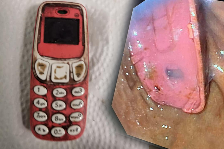 Dieses Nokia-Handy mussten Ärzte wieder entfernen. Ein 33-Jähriger hatte es zuvor verschluckt. Das rechte Bild zeigt einen Teil des Telefons.