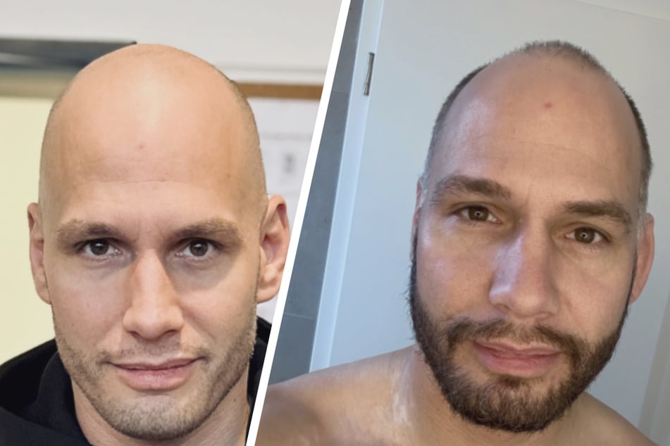 Knapp zwei Wochen ungesunder Lifestyle haben Spuren bei Flying Uwe (38) hinterlassen.