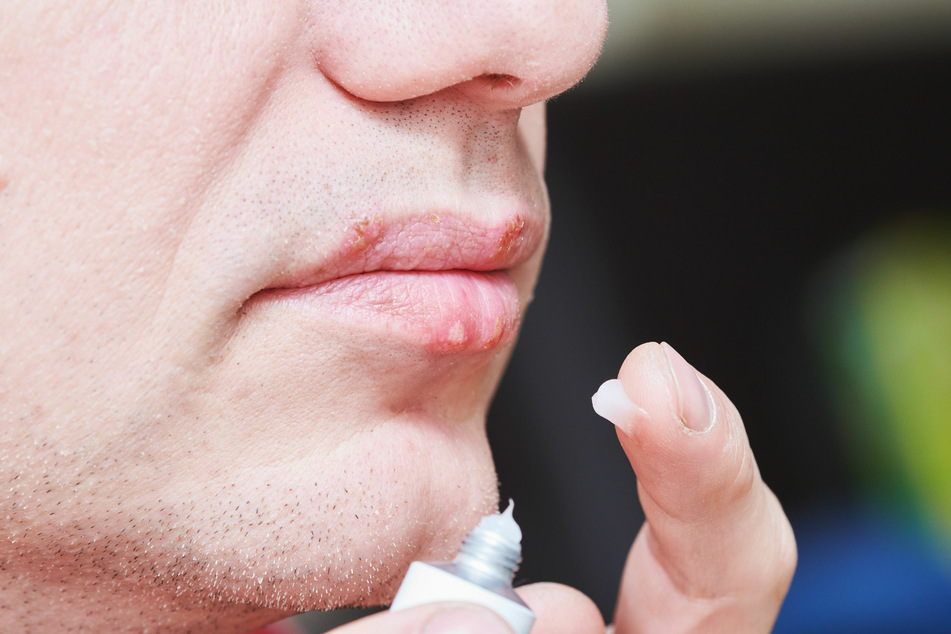 Ein Mann cremt sich seine Lippen mit ein (Symbolbild). Herpes kann nervig sein, aber mit der richtigen Behandlung kommen (die meisten) Menschen damit zurecht.