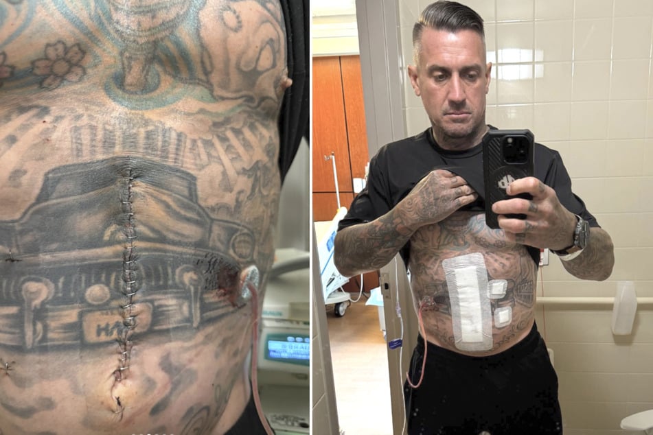 歌手ピンクの夫であるキャリー・ハート(49)が、大きく縫合された腹の傷をインスタグラムに公開。