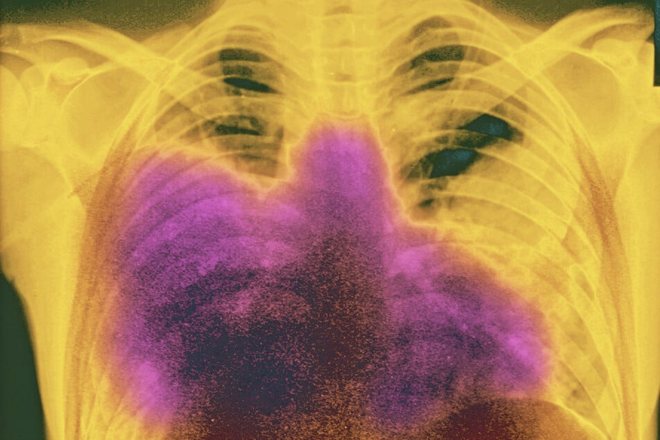 New York City's Upper East Side has seen 67 of Legionnaires' disease in the latest outbreak.