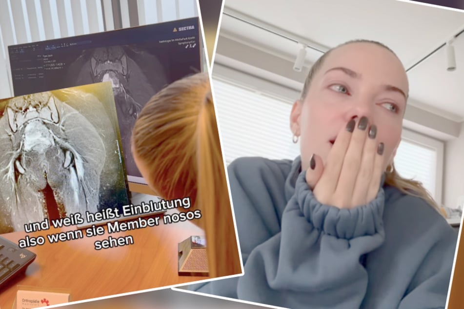 Die Influencerin hat sich einen dicken Bluterguss rund ums Steißbein eingefangen.