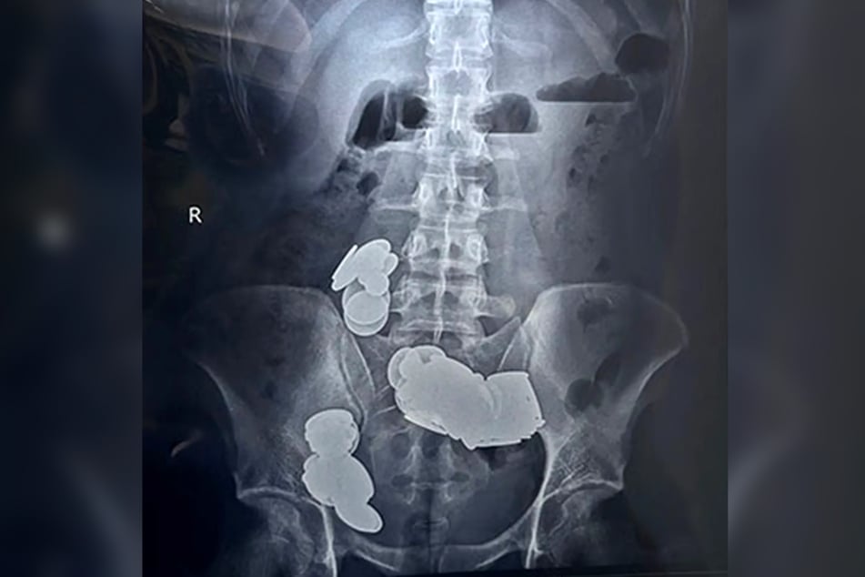 Auf Röntgenaufnahmen waren die Metallklumpen im Verdauungstrakt des Mannes deutlich zu sehen.