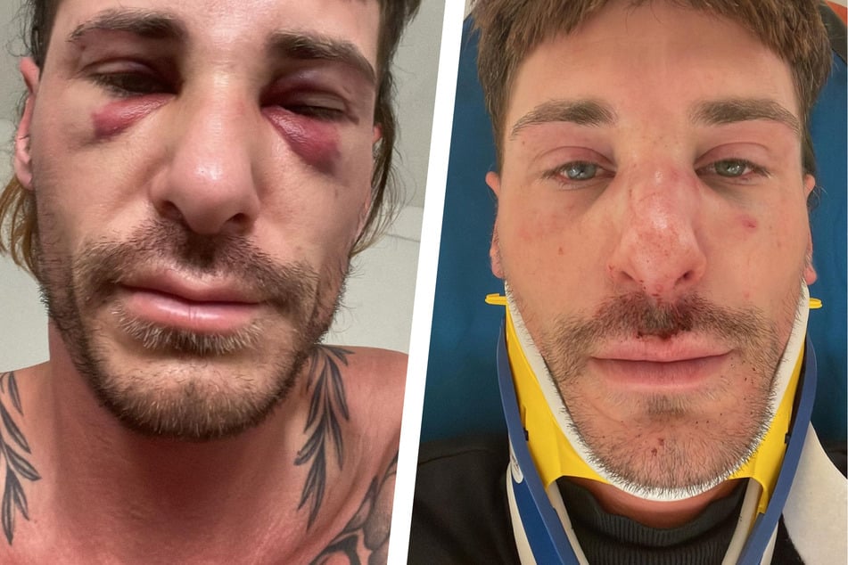 Blutergüsse und ein geschwollenes Gesicht – Pitzi Müller (32) zeigt auf Instagram, wie übel er zugerichtet worden ist.