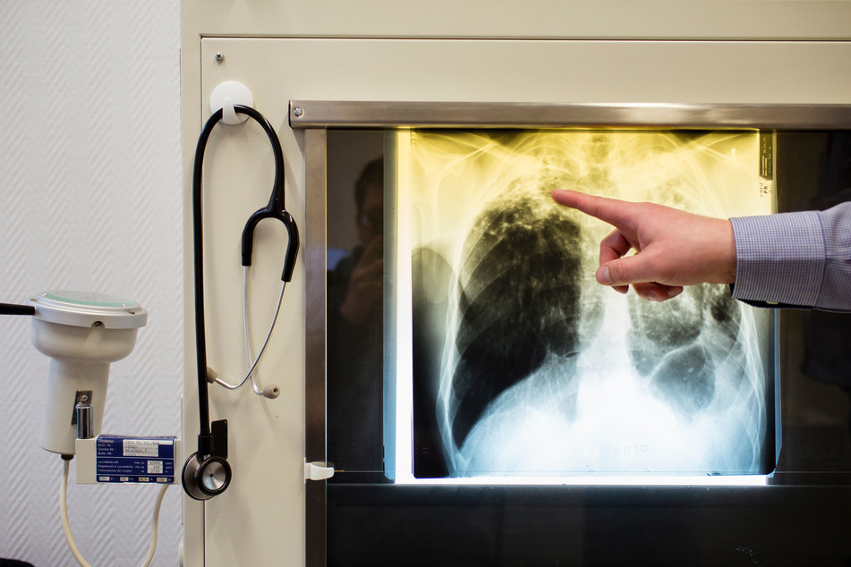 Die Tuberkulose-Bakterien befallen überwiegend die Lunge. Ohne Behandlung kann die Erkrankung tödlich enden.