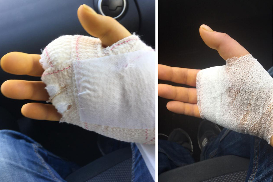 Im Dezember 2018 musste der Finger von Henrik Kriegbaum Plettner amputiert werden.