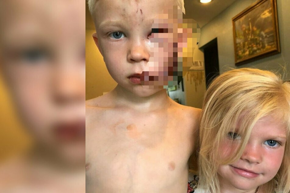 Bridger Walker (6). Aufgrund der heftigen Wunde des Jungen zeigen wir das Bild verpixelt. © Instagram/nicolenoelwalker