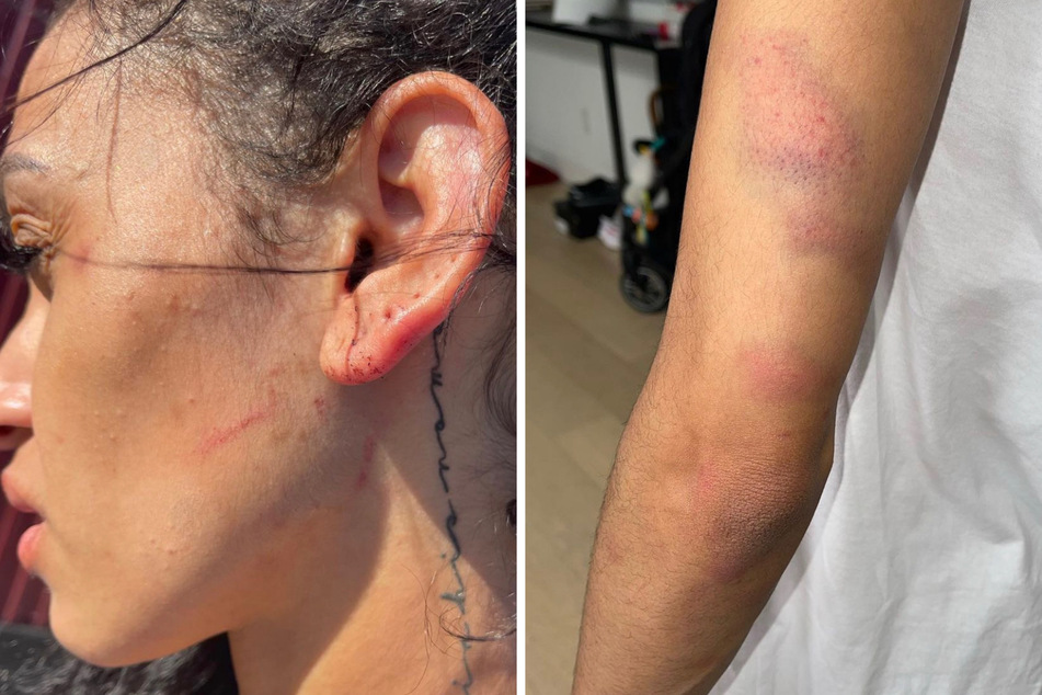 Mychelle Johnson posted photos of her alleged injuries on Instagram.