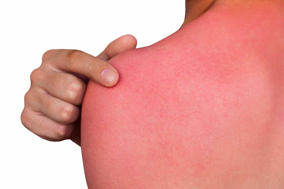 Sonnenbrand sollte definitiv nicht auf die leichte Schulter genommen werden.