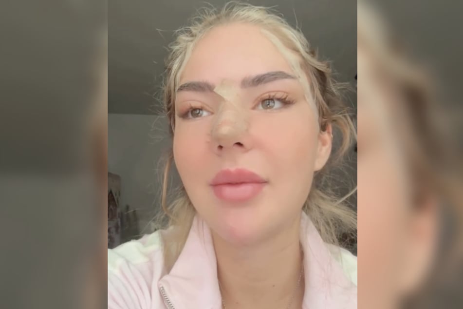 Die Influencerin unterzog sich einer Schönheits-OP und zeigte sich schon ein paar Tage danach auf Instagram.