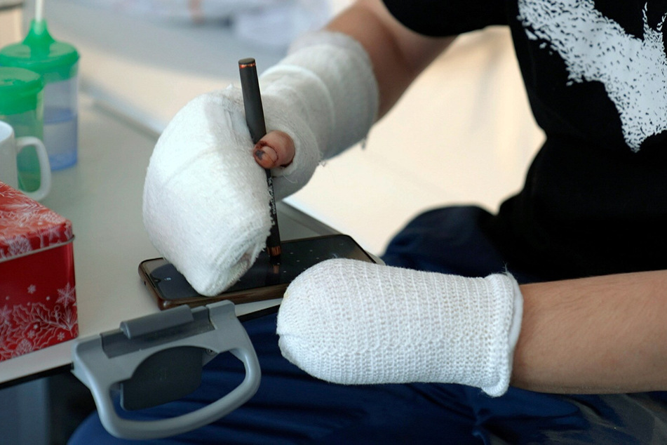Ein 19-Jähriger wird in einer Klinik in Halle behandelt, er hat nicht nur seine linke Hand, sondern auch auf einer Seite sein Augenlicht verloren.