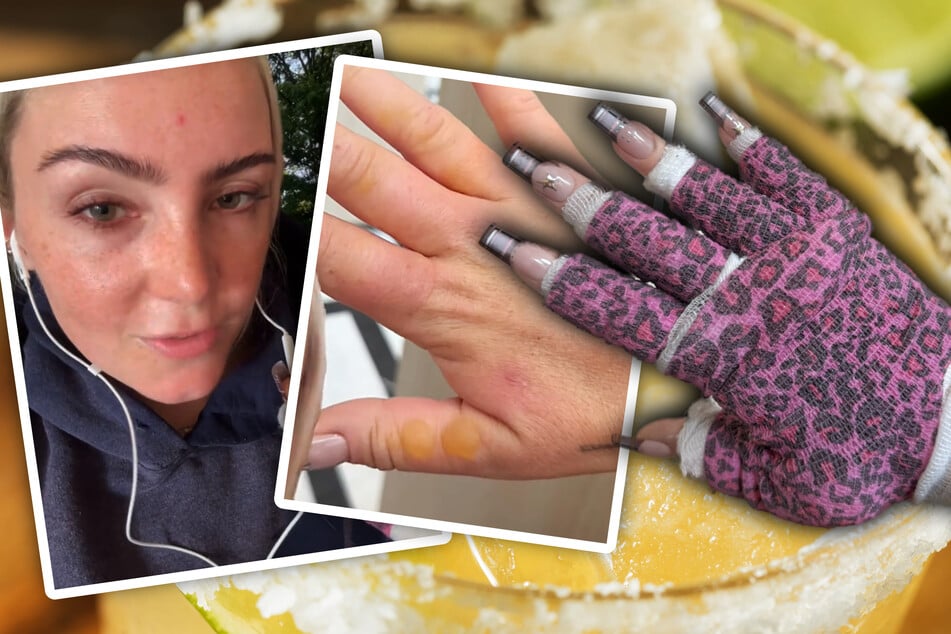 Frau presst Limetten aus und geht in die Sonne: Was mit ihren Händen passiert, wird zum Notfall