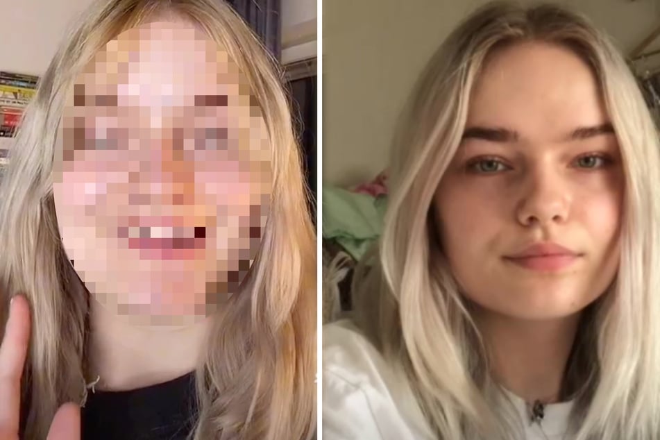 Frau berichtet von Horrorerfahrung mit Botox und zeigt schockierendes Ergebnis