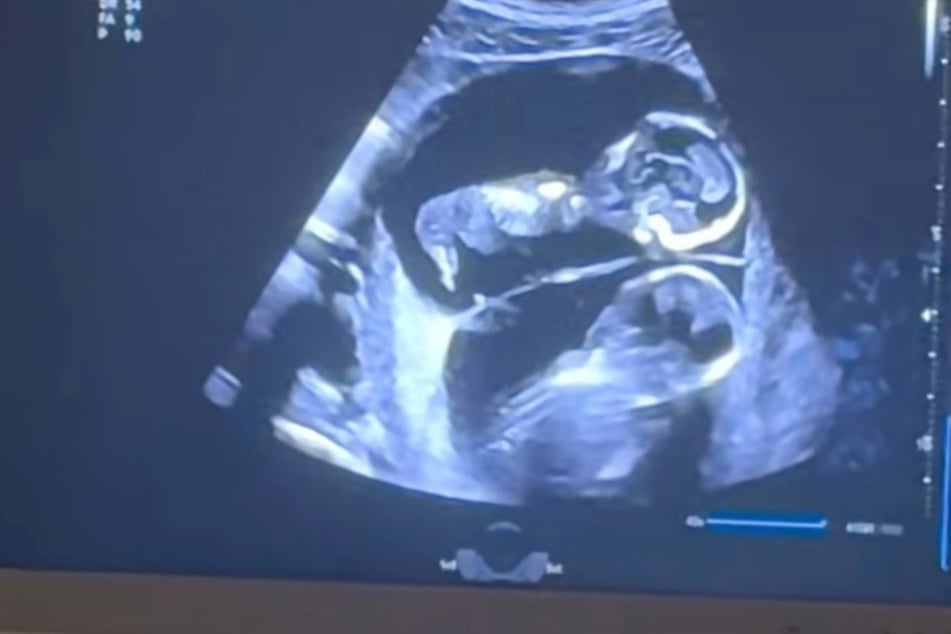 In dem Ultraschall-Video sieht es so aus, als würde der obere Zwilling dem unteren Küsschen geben.