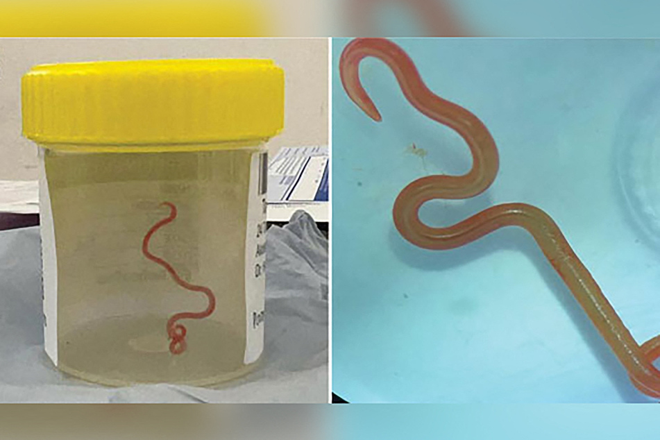 A three-inch parasitic roundworm, called Ophidascaris robertsi, was discovered alive in an Australian woman's brain.