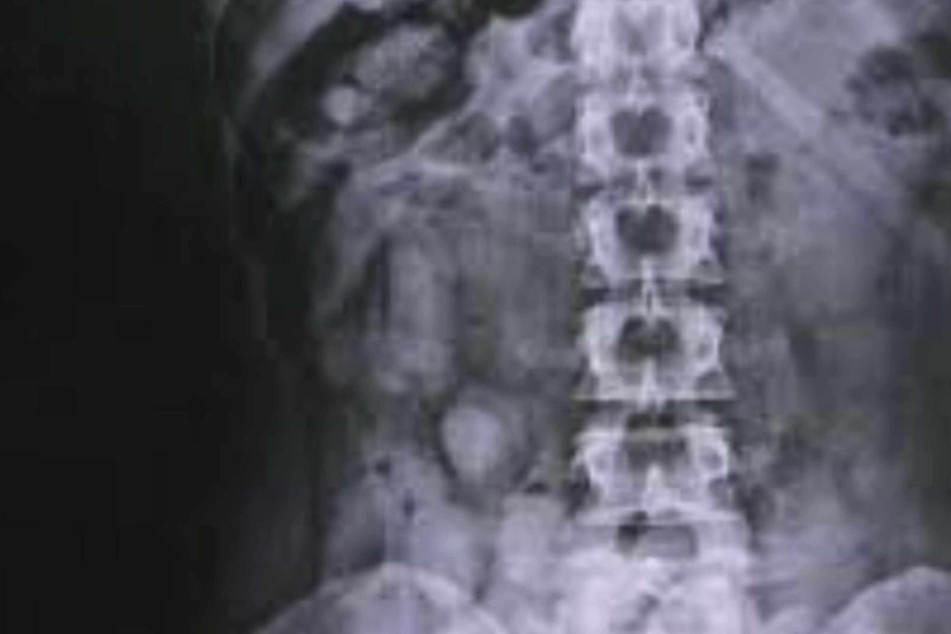 Shocking X-ray reveals cocaine smugglers hid drugs in secret body parts