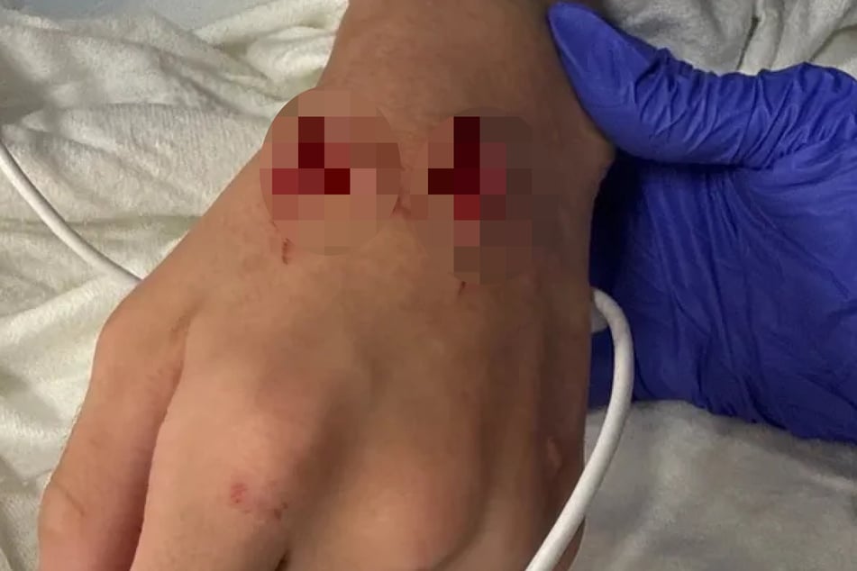 Auch an seiner Hand erlitt der 13-Jährige Bissverletzungen.
