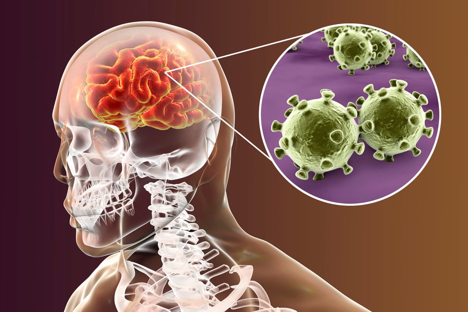 Meningitis to zapalenie opon mózgowo-rdzeniowych. (Zdjęcie symboliczne)