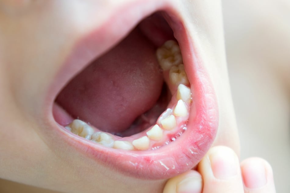 Verfärbungen oder Flecken auf der Zunge können ein Symptom für eine Infektion mit Corona sein.