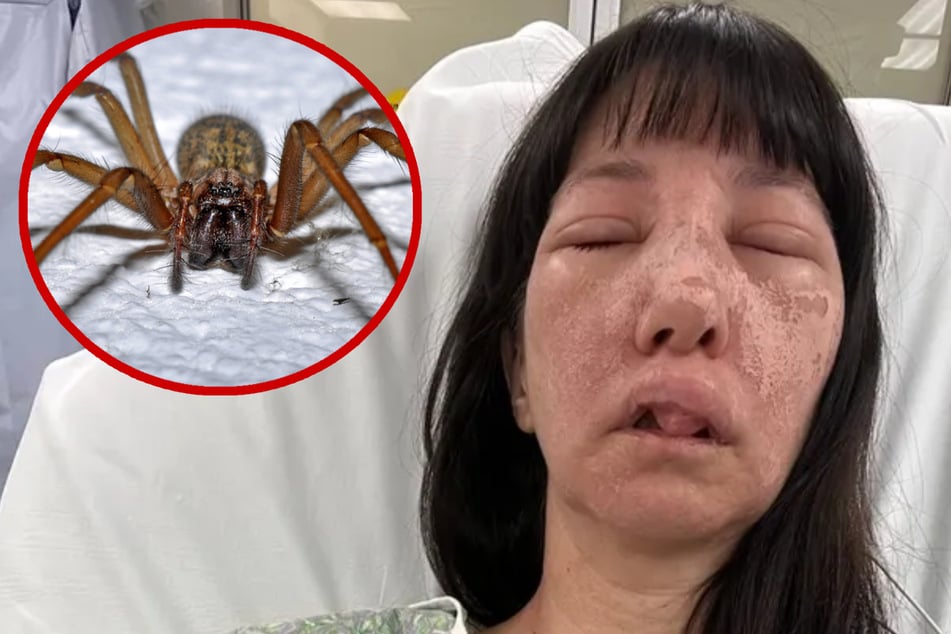 Schmerzen, Ausschlag, Augenschäden: Frau landet nach Spinnenbiss im Krankenhaus
