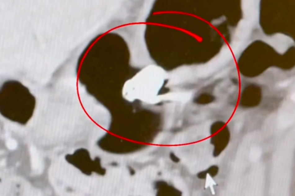 Die Ultraschalluntersuchung brachte Klarheit: Der AirPod versteckte sich im Magen!