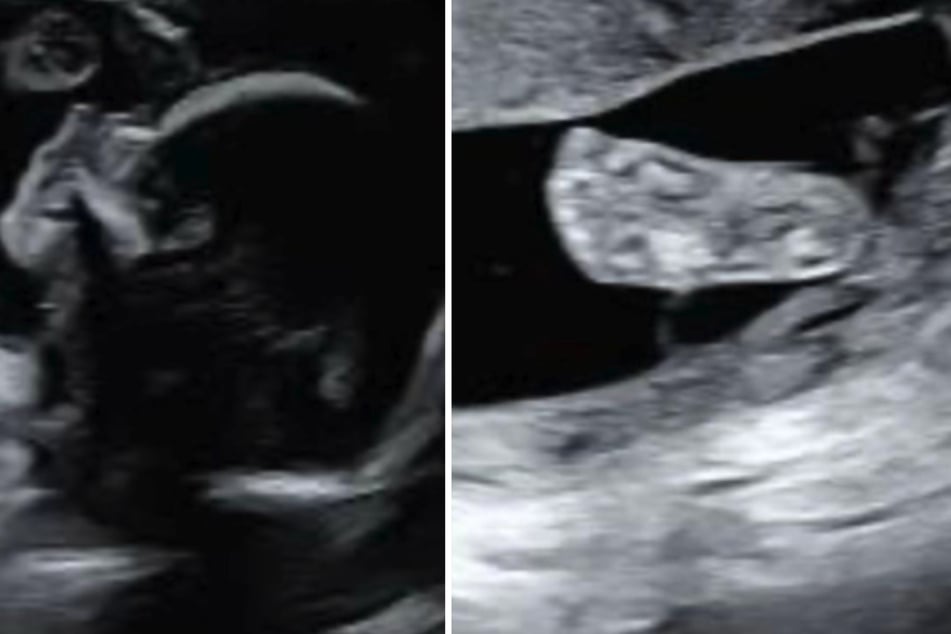 Der Ultraschalltermin einer Schwangeren aus Schottland verlief anders als geplant.