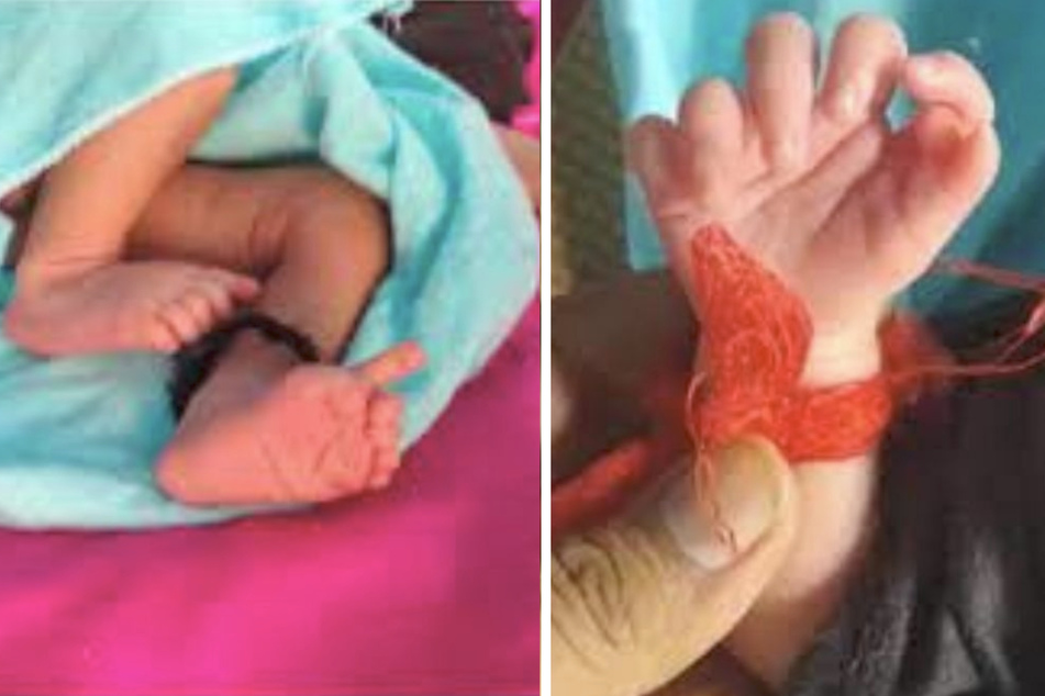 Das kleine Mädchen wurde mit 12 Zehen und 14 Fingern geboren.