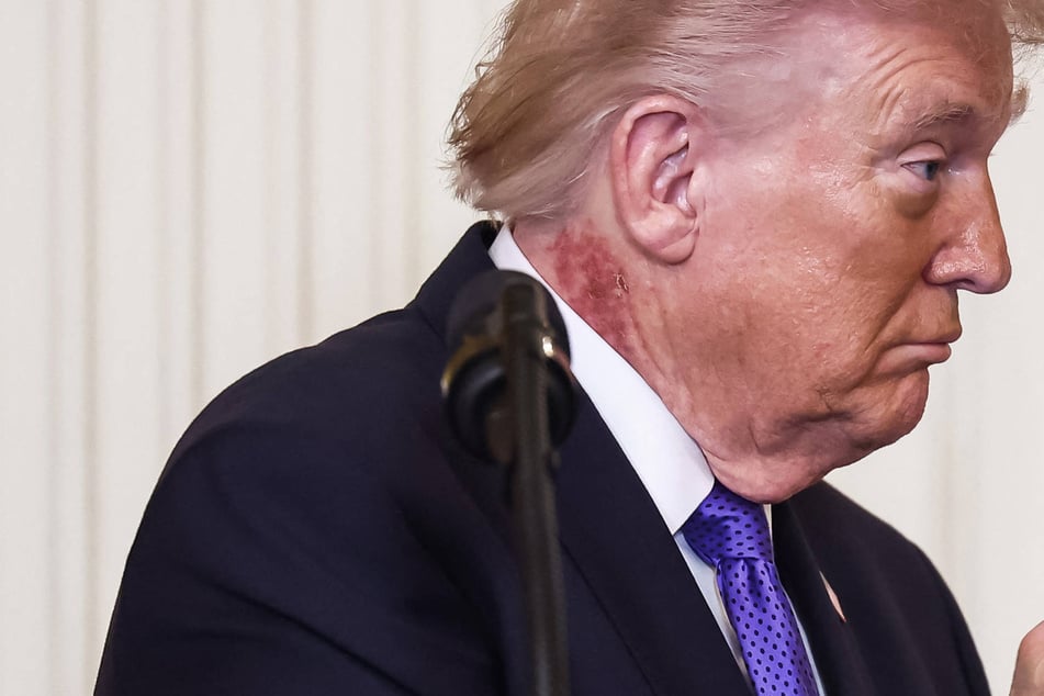 White House insists Trump is using preventative treatment for his blotchy red rash