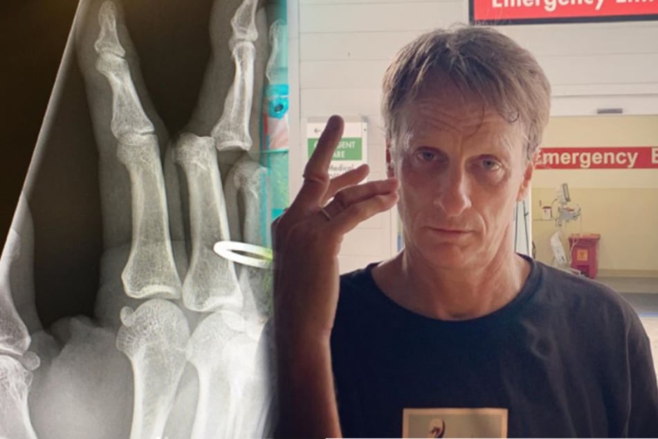 Tony Hawk präsentiert seinen gebrochenen Finger.
