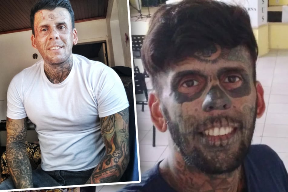 Riesiger Unterschied: Leandro vor und nach der Laserbehandlung.