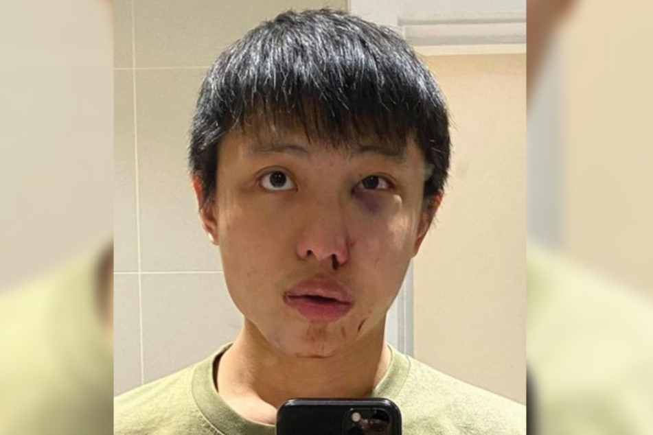 Das 23-jährige Opfer wurde übel zugerichtet, wie ein Bild bei Twitter zeigt.