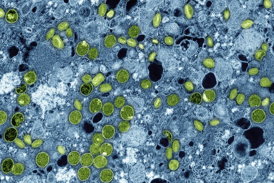 Bei vier Mitgliedern einer Familie in NRW war eine Infektion mit der neuen Variante des Mpox-Virus (vormals Affenpocken) nachgewiesen worden. (Symbolbild)