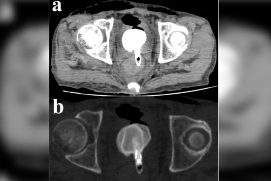 Ein CT-Scan eines Patienten in Japan zeigte einen Fremdkörper in der Nähe des Rektums.