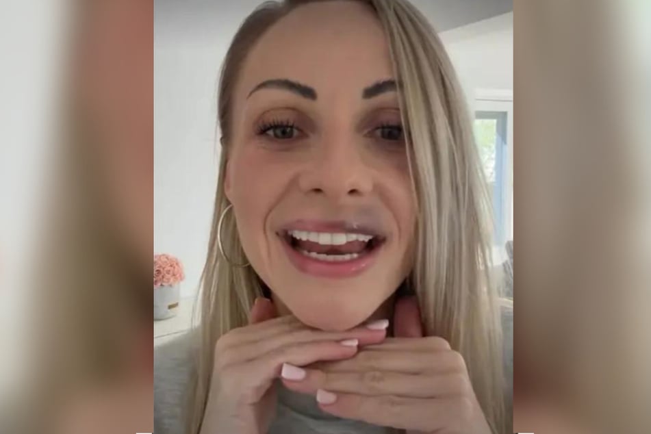 Das Hämatom an der Oberlippe von Marta Arndt (36) ist in ihrer Instagram-Story deutlich sichtbar.