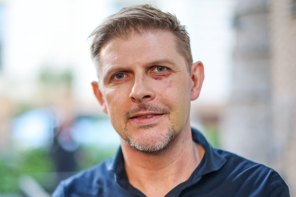 Matthias Ecke (43, SPD) wurde im Mai 2024 attackiert und verletzt.