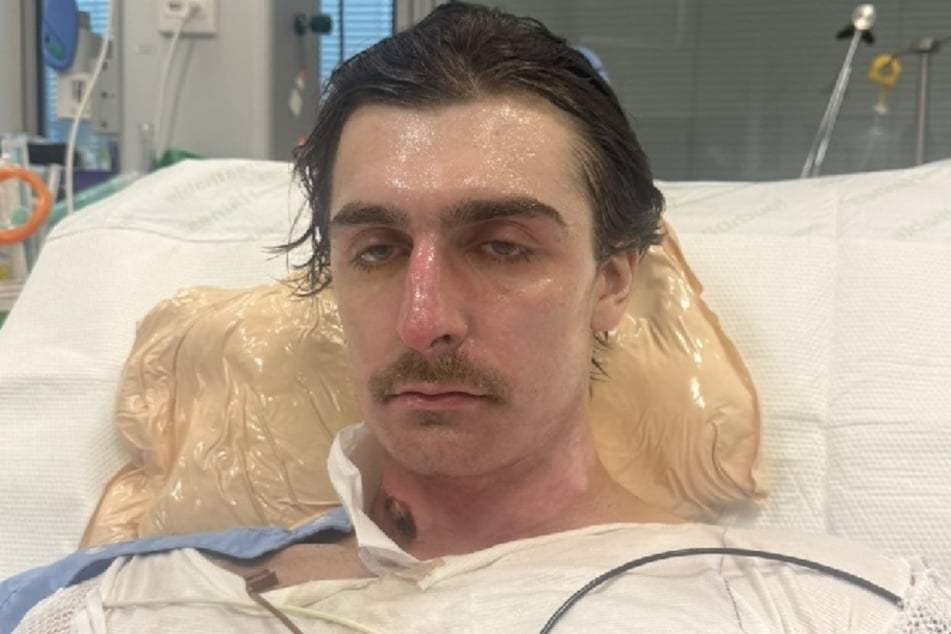 Über 75 Prozent des Körpers von Australier Lachie Perrem (25) verbrannten infolge einer Explosion.