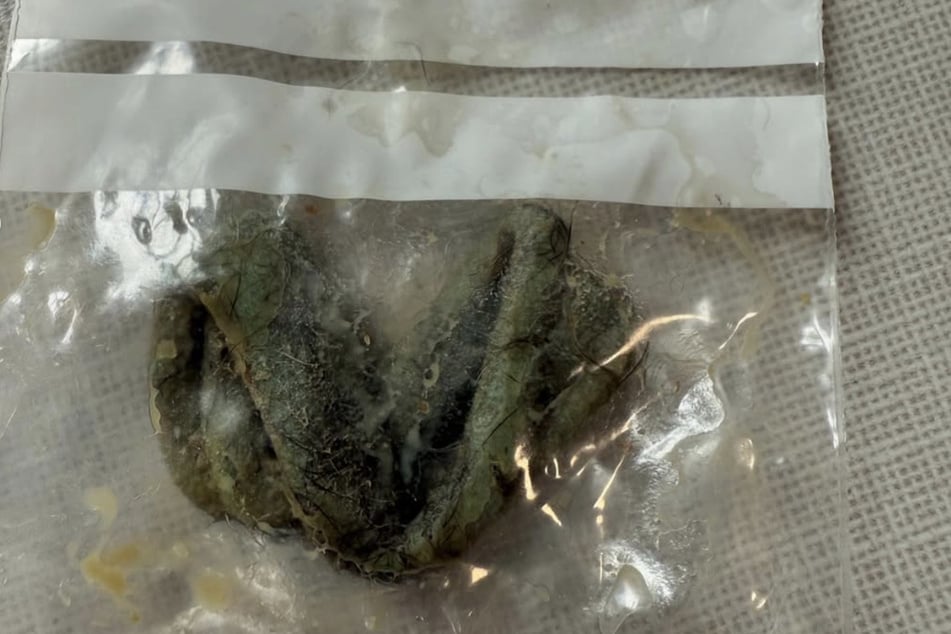 Le caoutchouc pour cheveux que Lola a avalé menaçait de provoquer une occlusion intestinale et a dû être retiré chirurgicalement.