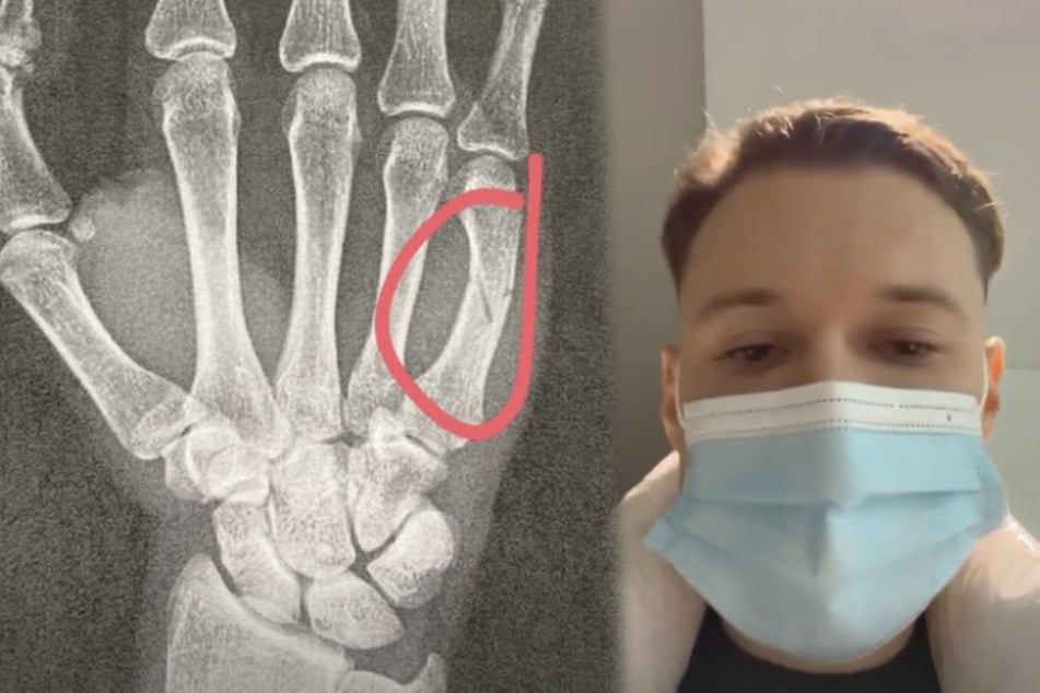 Die Röntgenaufnahme von Youtuber inscope 21 (26) zeigt, dass der kleine Finger seiner rechten Hand gebrochen ist. (Fotomontage)
