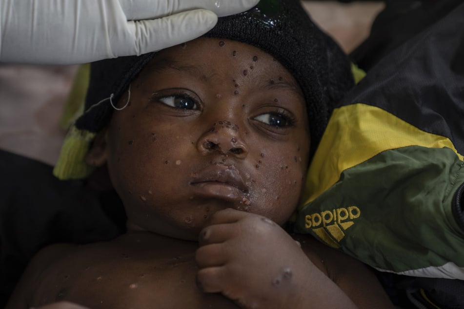 Ein an Mpox erkrankter Junge liegt im Krankenhaus, in Kamituga, Provinz Süd-Kivu, die das Epizentrum des jüngsten Ausbruchs der Krankheit im Osten des Kongo ist.