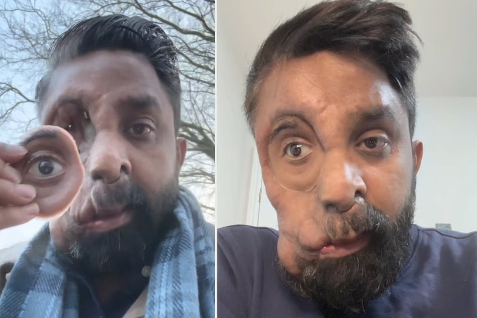 Amit Ghose (36) aus Birmingham leidet unter Neurofibromatose Typ 1, was unter anderem dazu führte, dass ihm in jungen Jahren sein Auge entfernt werden musste.