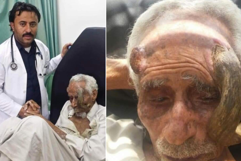 Offenbar soll sich der Zustand des Jemeniten nach der Amputation seiner Hauthörner rapide verschlechtert haben.