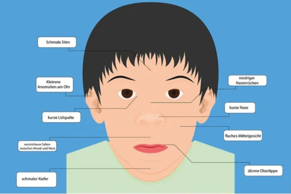 Kinder, die an einer fetalen Alkoholspektrumstörung (FASD) leiden, haben oft charakteristische Gesichtsmerkmale, die in dieser Grafik beschrieben sind.