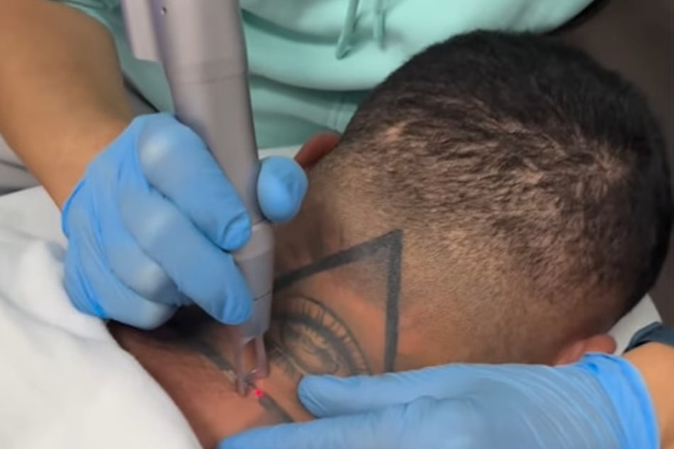 Im Tattoo-Studio ließ sich Samra das ungeliebte Motiv weglasern.