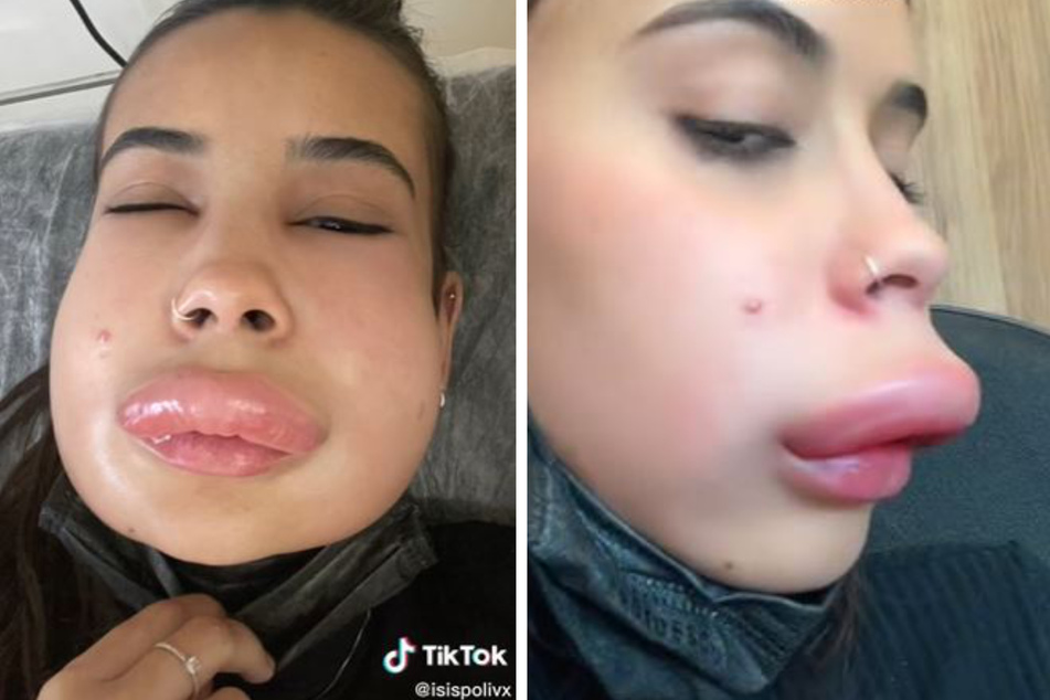Isis' Gesicht schwoll nach der Behandlung mit Hyaluronidase an. Besonders ihre Lippen waren betroffen. Die junge Frau kam sofort ins Krankenhaus.