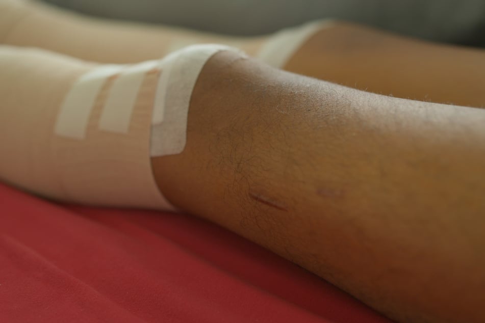 In den nächsten Monaten klickt er die eingesetzte Stange selber immer weiter auseinander, um an Größe zu gewinnen.