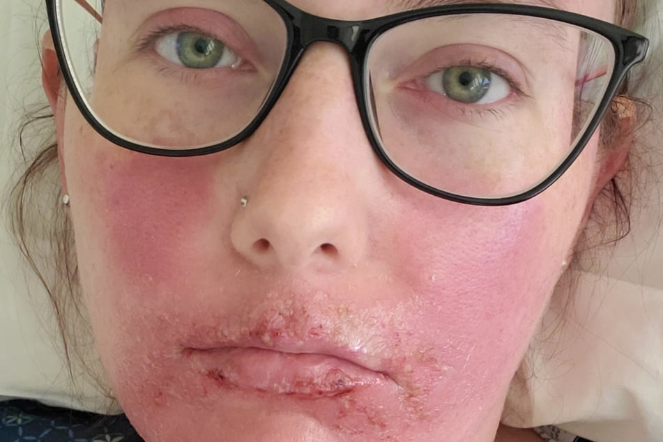 "Im Grunde verbrennt die Haut von innen heraus"; erklärt SJS-Patientin Emily Richardson (36).