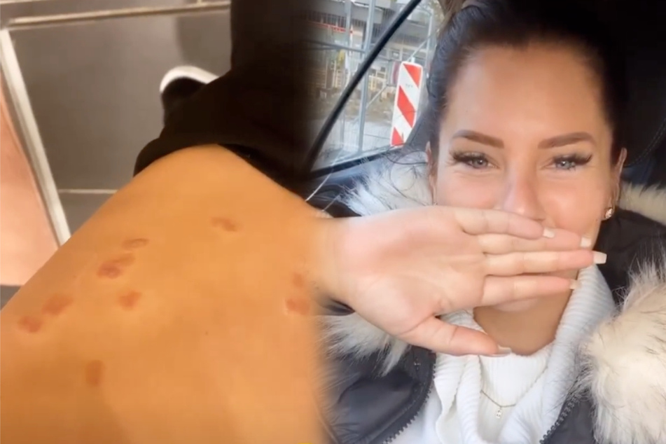 Jenny muss nach dem Überraschungs-Lasern lachen, zeigt später ihre Oberschenkel. Die Hautreizungen nach der Behandlung sind nicht zu übersehen. (Montage)